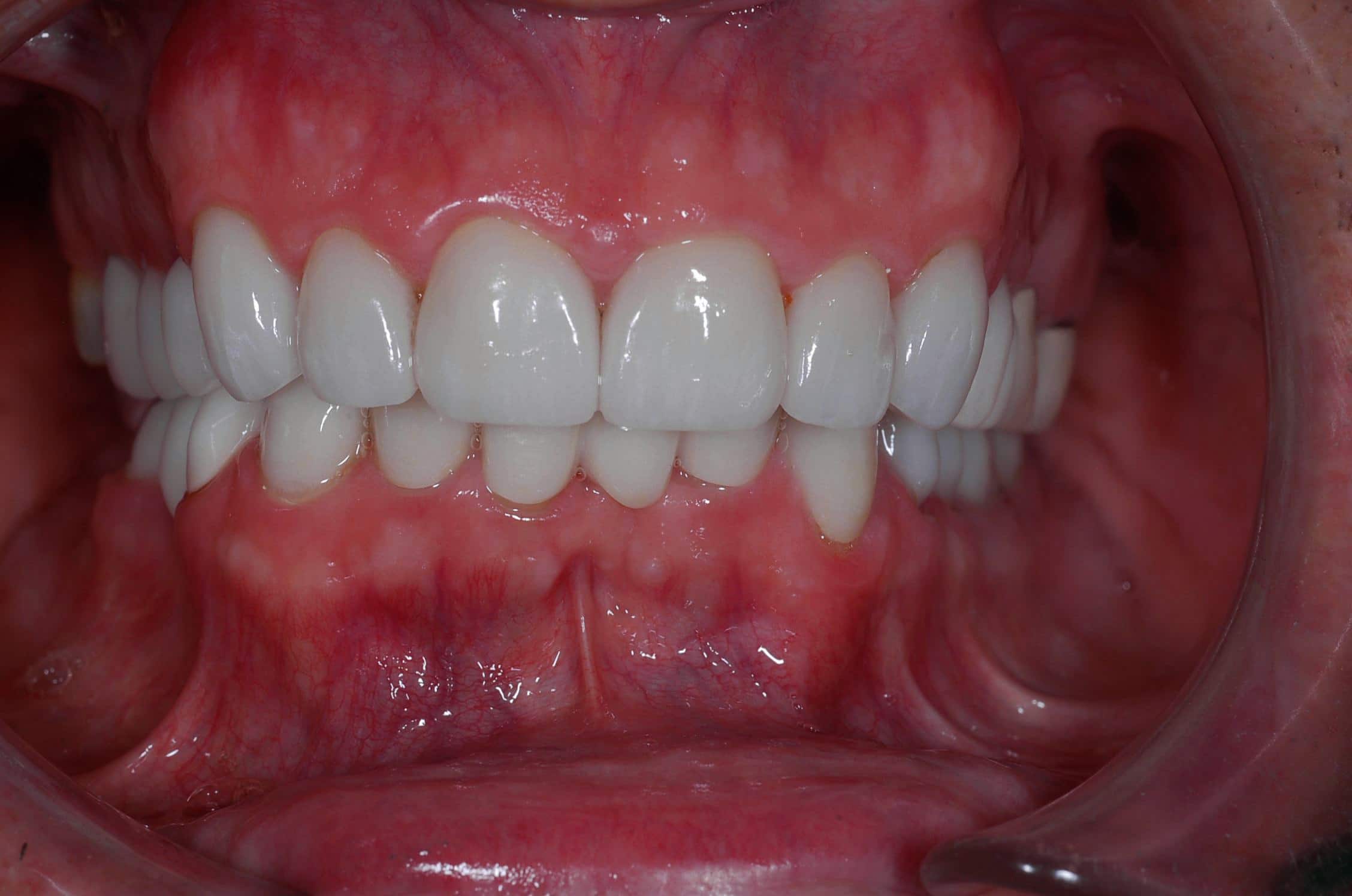 eroding translucent tooth